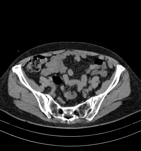 File:Autosomal dominant polycystic kidney disease (Radiopaedia 41918-44922 Axial non-contrast 27).jpg