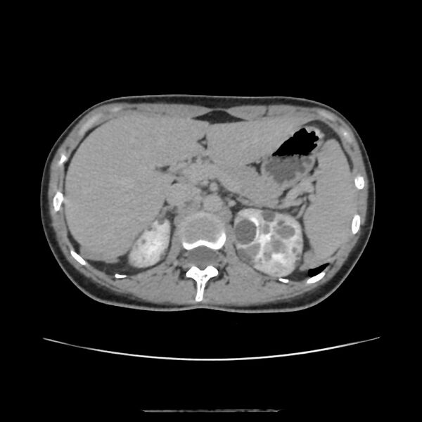 File:Autosomal dominant polycystic kidney disease - early onset (Radiopaedia 40734-43387 D 3).jpg