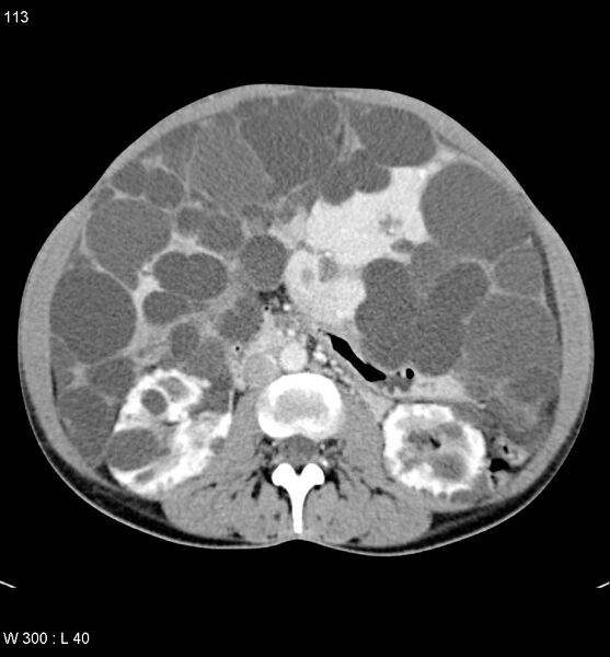 File:Autosomal dominant polycystic kidney disease with extensive hepatic involvement (Radiopaedia 5204-6971 B 15).jpg