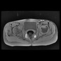 Avascular necrosis of the hip (Radiopaedia 29563-30067 Axial T1 fat sat 7).jpg