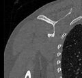 Avulsion fracture - greater tuberosity of humerus (Radiopaedia 71216-81514 Coronal bone window 52).jpg