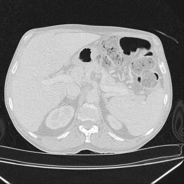File:Azygos lobe (Radiopaedia 38259-40275 Axial lung window 86).jpg