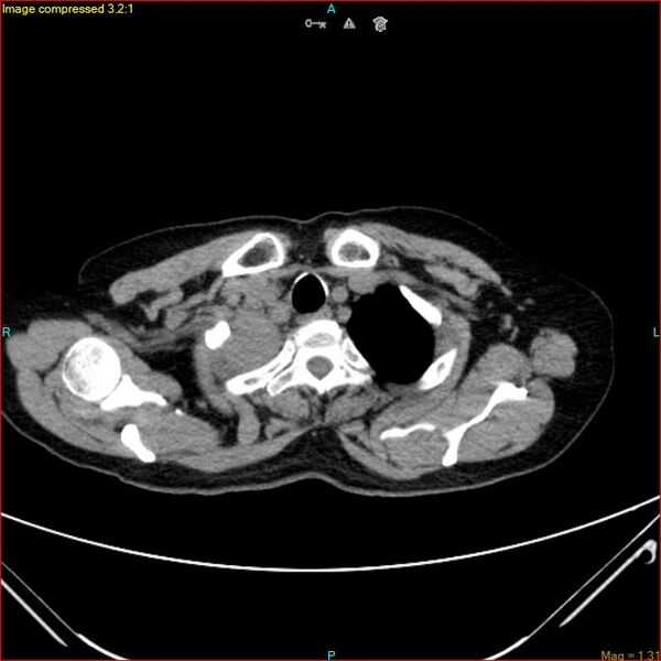 File:Azygos vein aneurysm (Radiopaedia 77824-90130 A 9).jpg