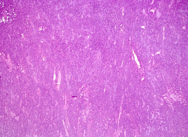 File:Basal cell adenoma - salivary gland (Radiopaedia 43989-47511 40x H&E 1).jpg