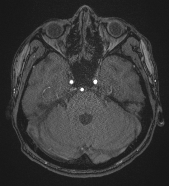 File:Basal ganglia subacute infarct (Radiopaedia 80201-93521 Axial MRA 26).png