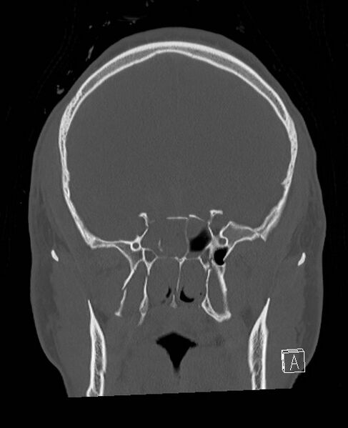 File:Base of skull fracture with bilateral Le Fort fractures (Radiopaedia 47094-51638 Coronal bone window 62).jpg