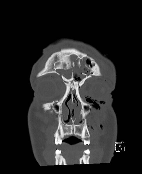 File:Base of skull fracture with bilateral Le Fort fractures (Radiopaedia 47094-51638 Coronal bone window 85).jpg