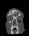 Base of skull fracture with bilateral Le Fort fractures (Radiopaedia 47094-51638 Coronal bone window 85).jpg