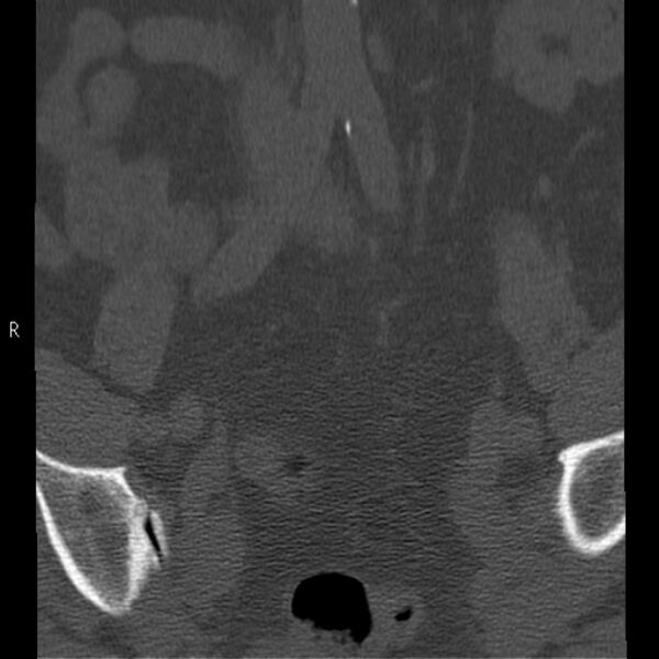 File:Bertolotti syndrome (Radiopaedia 24864-25128 Coronal bone window 2).jpg