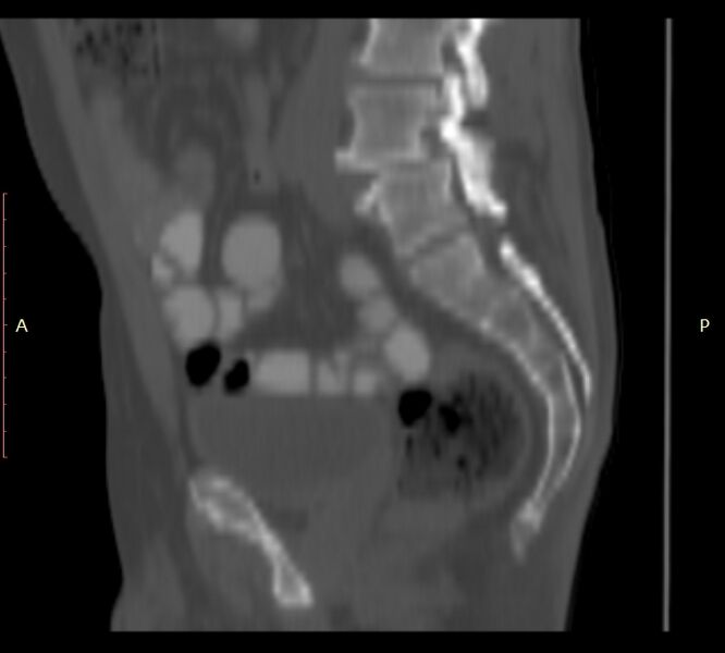 File:Bertolotti syndrome (Radiopaedia 58974-66235 Sagittal bone window 19).jpg