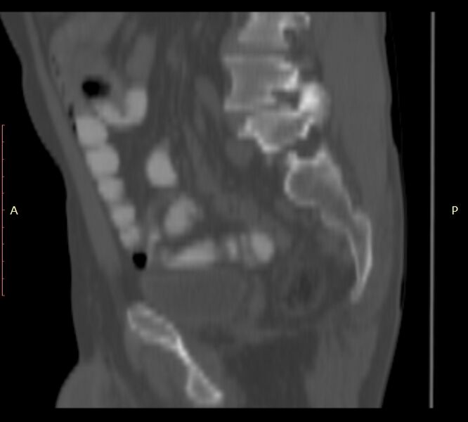 File:Bertolotti syndrome (Radiopaedia 58974-66235 Sagittal bone window 38).jpg