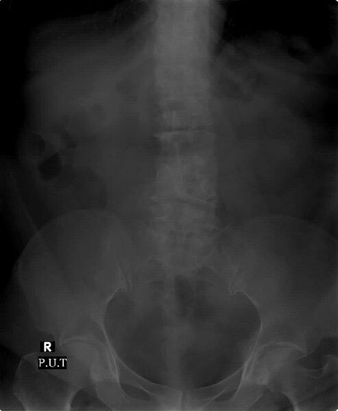 File:Bifid renal pelvis with ureteropelvic junction obstruction (Radiopaedia 18181).jpg