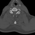 Bilateral C6-7 locked facet dislocation (Radiopaedia 28506-28748 Axial bone window 17).jpeg