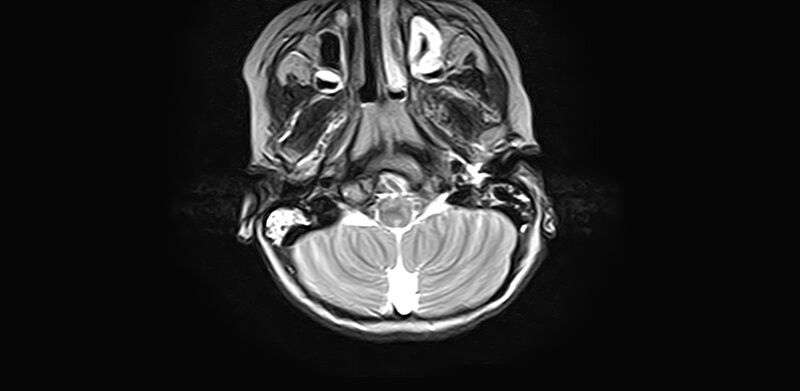 File:Bilateral Sprengel deformity with Klippel-Feil syndrome (Radiopaedia 66395-75650 Axial T2 2).jpg