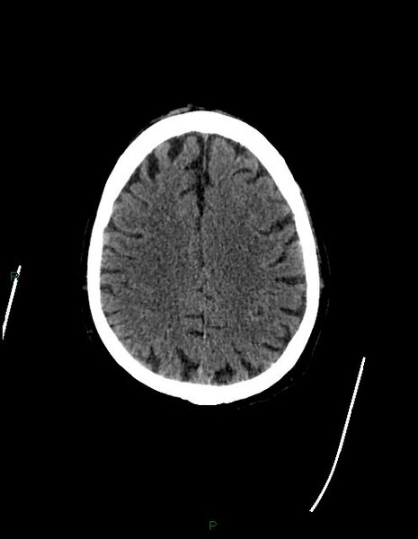 File:Bilateral acute middle cerebral artery territory infarcts (Radiopaedia 77319-89401 Axial non-contrast 63).jpg