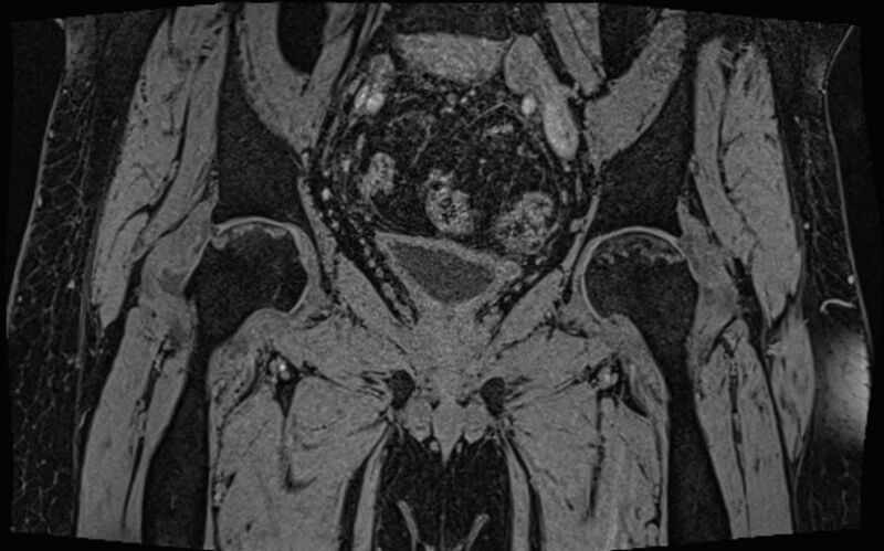 File:Bilateral avascular necrosis of femoral head (Radiopaedia 77116-89078 Coronal T2 we 42).jpg