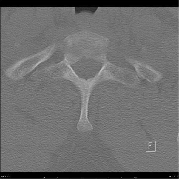 File:Bilateral cervical ribs (Radiopaedia 25868-26017 Axial bone window 47).jpg