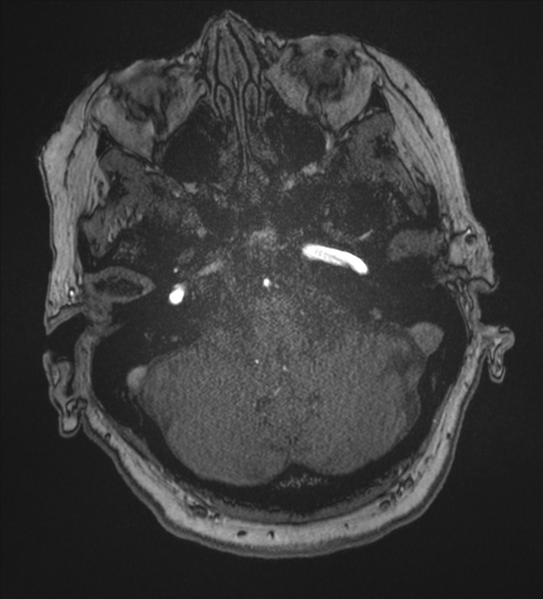 File:Bilateral fetal posterior communicating arteries (Radiopaedia 41286-44102 Axial MRA 29).png