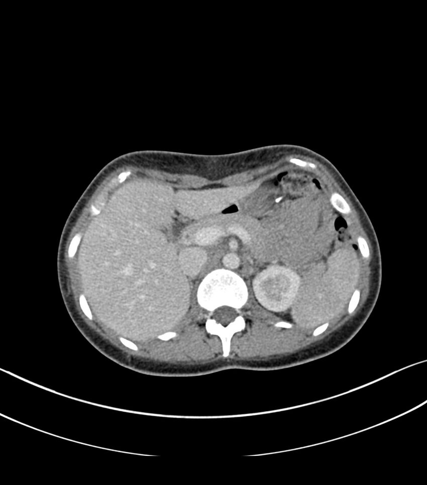 Bilateral kidney malrotation (Radiopaedia 72227-82749 A 6).jpg