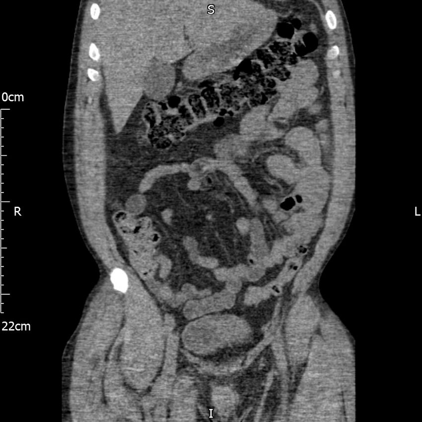 Bilateral medullary nephrocalcinosis with ureteric calculi (Radiopaedia 71269-81569 Coronal non-contrast 20).jpg