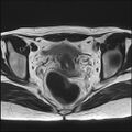 Bilateral ovarian endometriomas (Radiopaedia 87085-103347 Axial T2 13).jpg