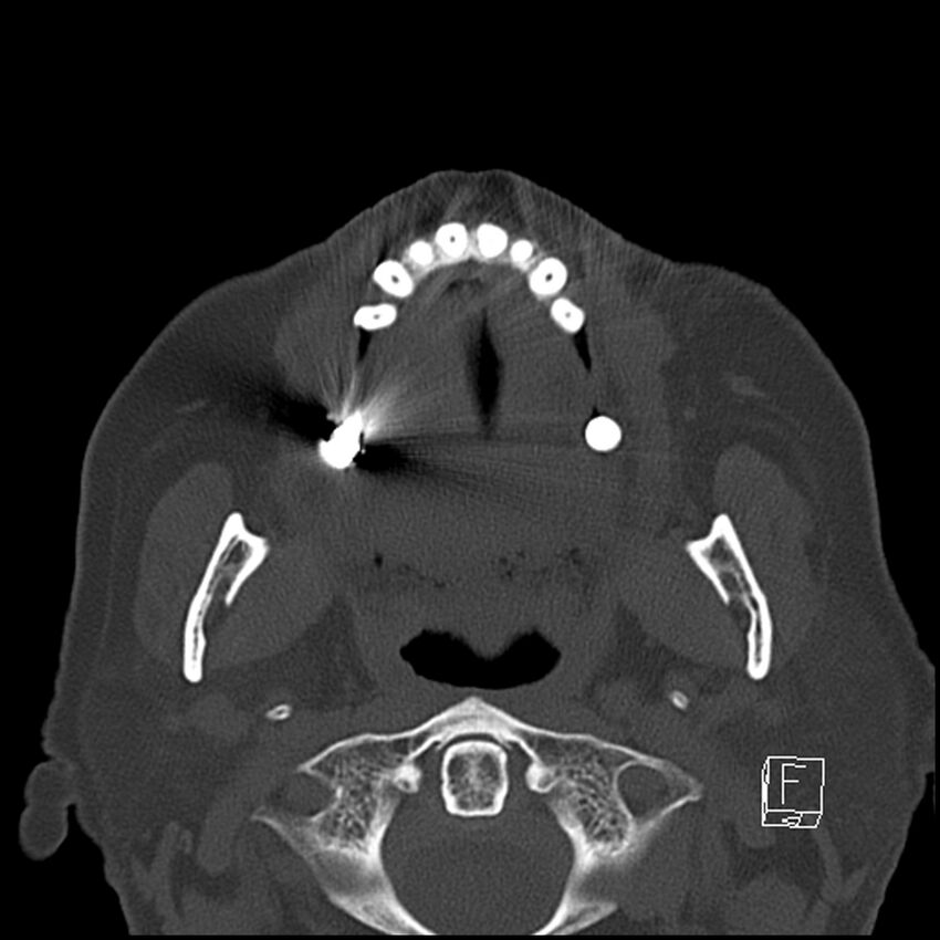 Bilateral palatine tonsilloliths on OPG and CT (Radiopaedia 75167-86247 Axial bone window 36).jpg