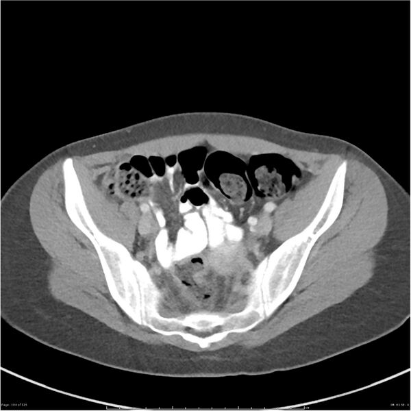 File:Bilateral ureteritis and cystitis (Radiopaedia 25340-25594 A 61).jpg