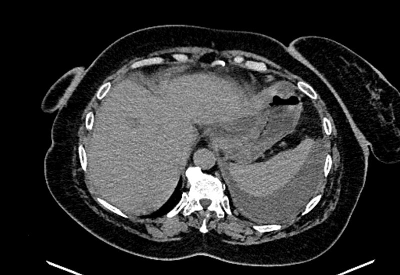 File:Biliary pancreatitis (Radiopaedia 72289-82823 Axial non-contrast 56).jpg