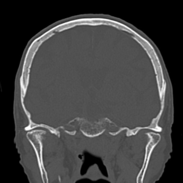 File:Biparietal osteodystrophy (Radiopaedia 46109-50463 Coronal bone window 53).jpg