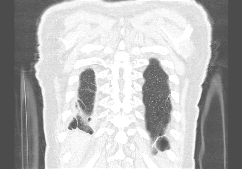 File:Birt-Hogg-Dubé syndrome (Radiopaedia 52578-58491 Coronal lung window 59).jpg