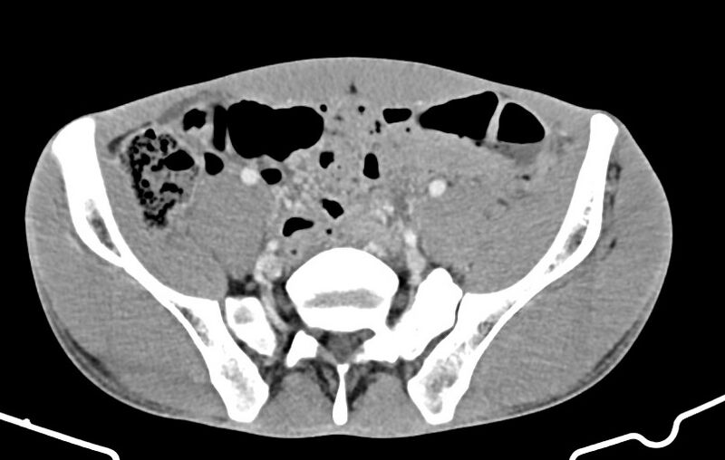 File:Blunt injury to the small bowel (Radiopaedia 74953-85987 A 143).jpg