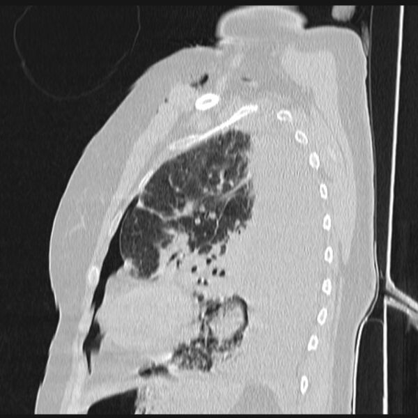 File:Boerhaave syndrome (Radiopaedia 45644-49799 Sagittal lung window 61).jpg