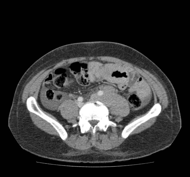 File:Bowel lymphoma complicated by bleeding after therapy (Radiopaedia 55601-62107 A 55).jpg