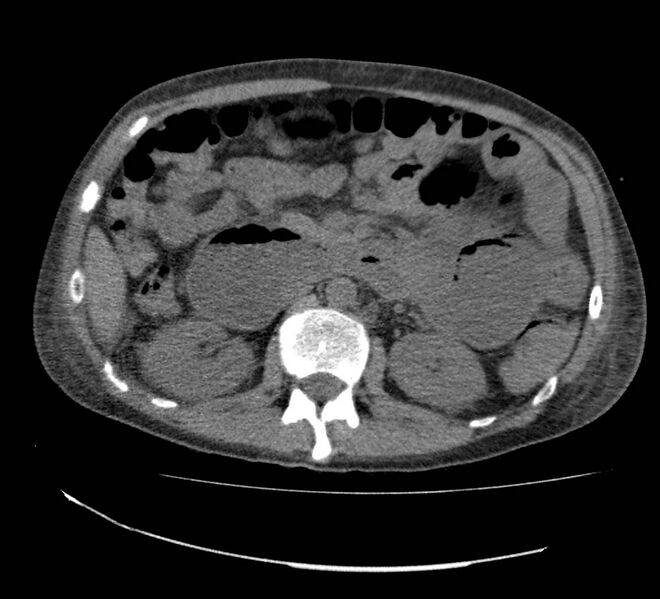 File:Bowel lymphoma complicated by bleeding after therapy (Radiopaedia 55601-62110 Axial non-contrast 34).jpg