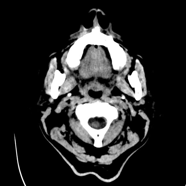 File:Brain Pantopaque remnants (Radiopaedia 78403-91048 Axial non-contrast 2).jpg
