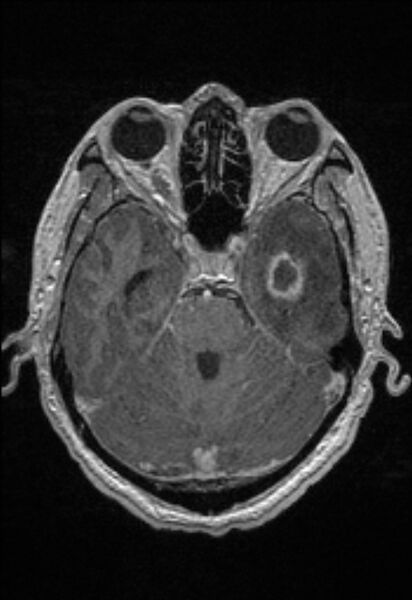 File:Brain abscess with ventriculitis (Radiopaedia 85703-101495 Axial T1 C+ 61).jpg