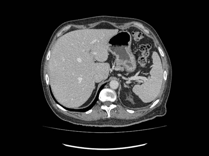 Brain metastases from renal cell carcinoma (Radiopaedia 42222-45328 B 1).jpg