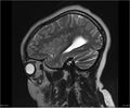 Brainstem glioma (Radiopaedia 21819-21775 Sagittal T2 4).jpg