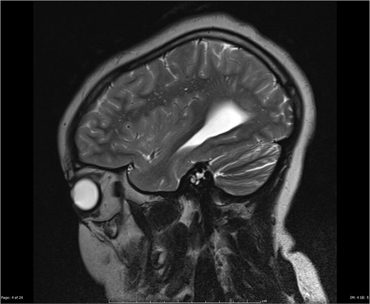File:Brainstem glioma (Radiopaedia 21819-21775 Sagittal T2 4).jpg