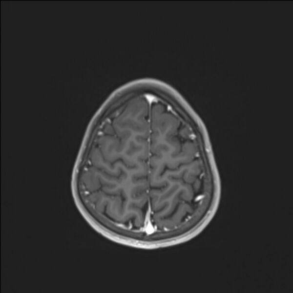 File:Brainstem glioma (Radiopaedia 70548-80674 Axial T1 C+ 132).jpg