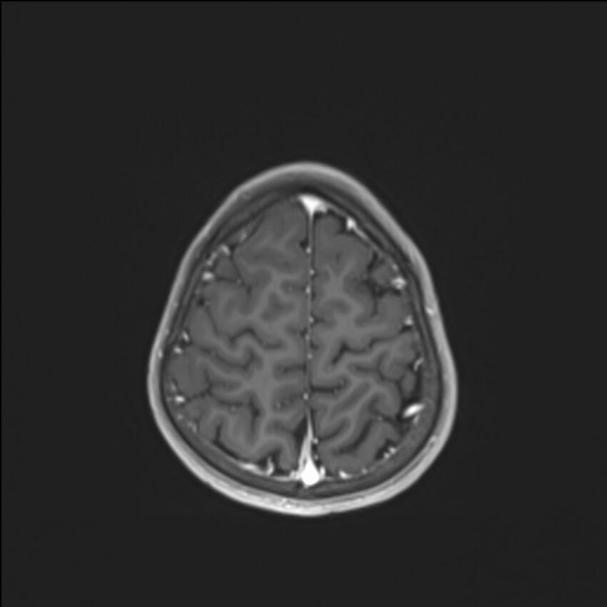 Brainstem glioma (Radiopaedia 70548-80674 Axial T1 C+ 132).jpg