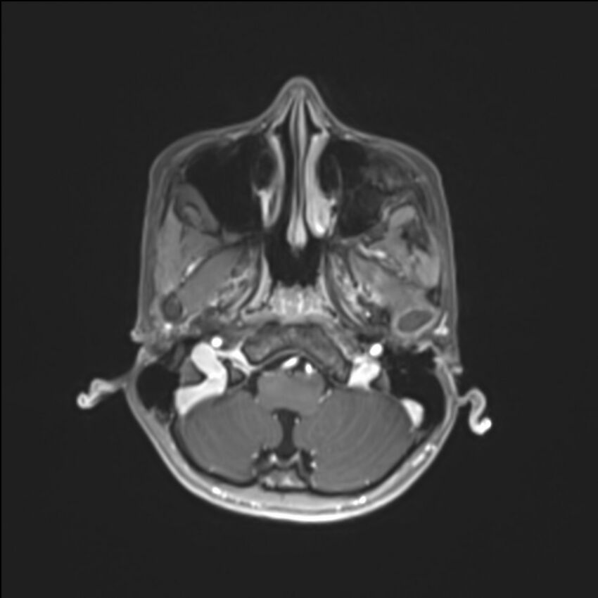 Brainstem glioma (Radiopaedia 70548-80674 Axial T1 C+ 29).jpg