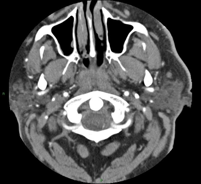 File:Brainstem hemorrhage (Radiopaedia 58794-66028 D 6).jpg