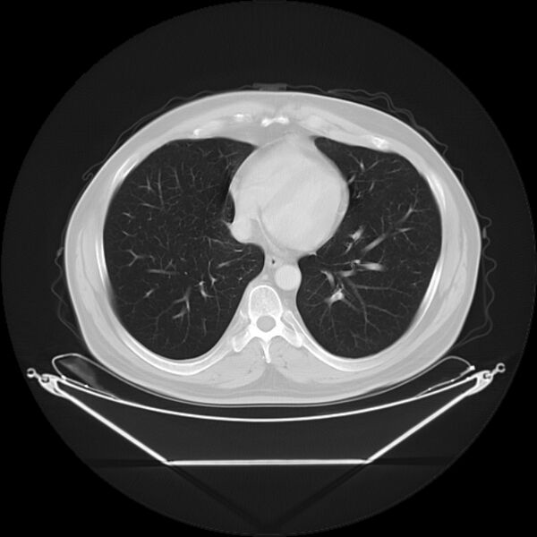 File:Bronchogenic carcinoma with upper lobe collapse (Radiopaedia 29297-29726 Axial lung window 23).jpg