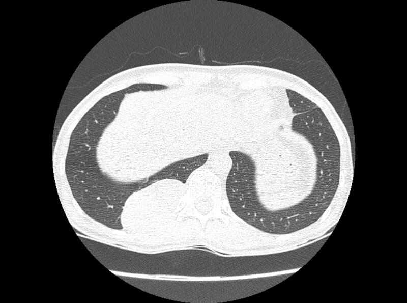 File:Bronchogenic cyst (Radiopaedia 80273-93615 Axial lung window 28).jpg