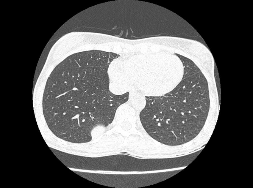 Bronchogenic cyst (Radiopaedia 80273-93615 Axial lung window 7).jpg