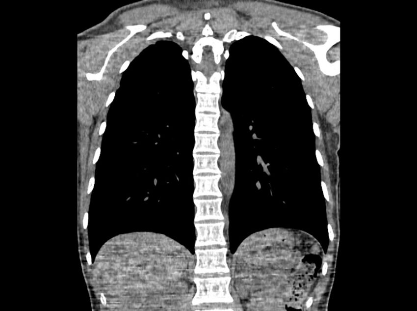 Bronchogenic cyst (Radiopaedia 80273-93615 D 74).jpg