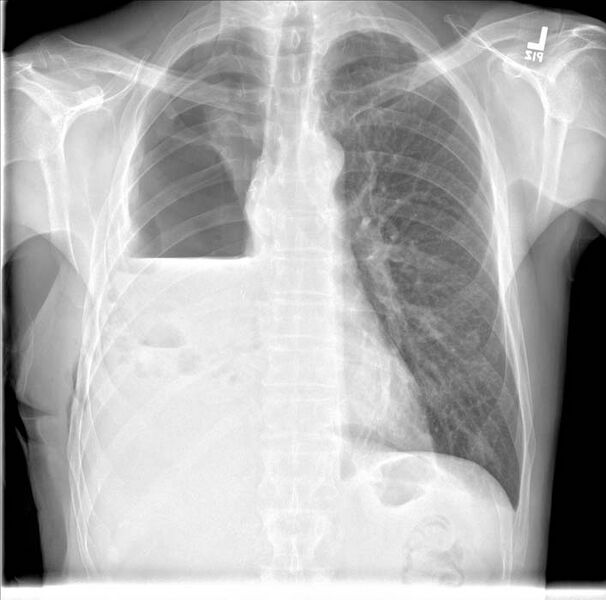 File:Bronchopleural fistula (Radiopaedia 11262-49081 Frontal chest radiograph 2).jpg