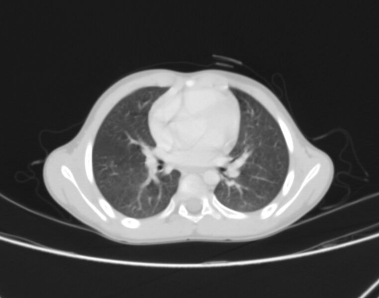File:Bronchus suis (Radiopaedia 68131-77620 Axial lung window 44).jpg