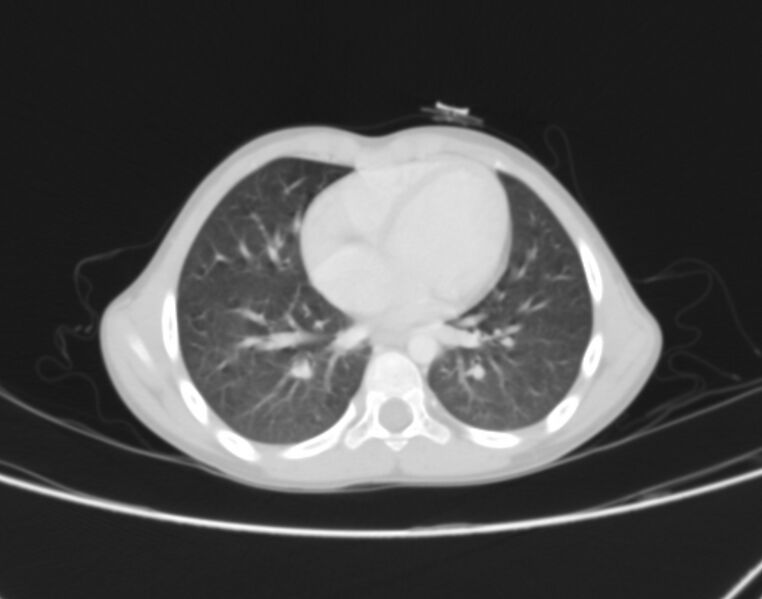 File:Bronchus suis (Radiopaedia 68131-77620 Axial lung window 63).jpg